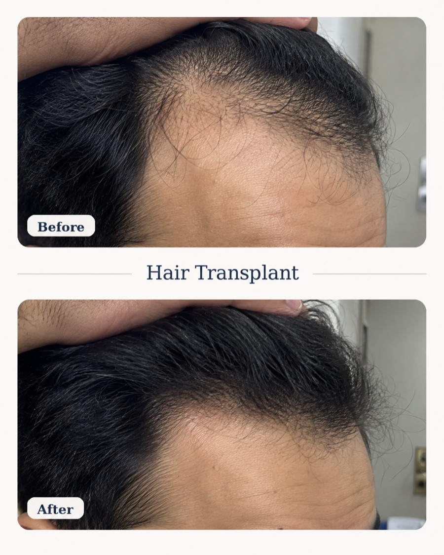Hair transplant before and after — temple hairline restoration
