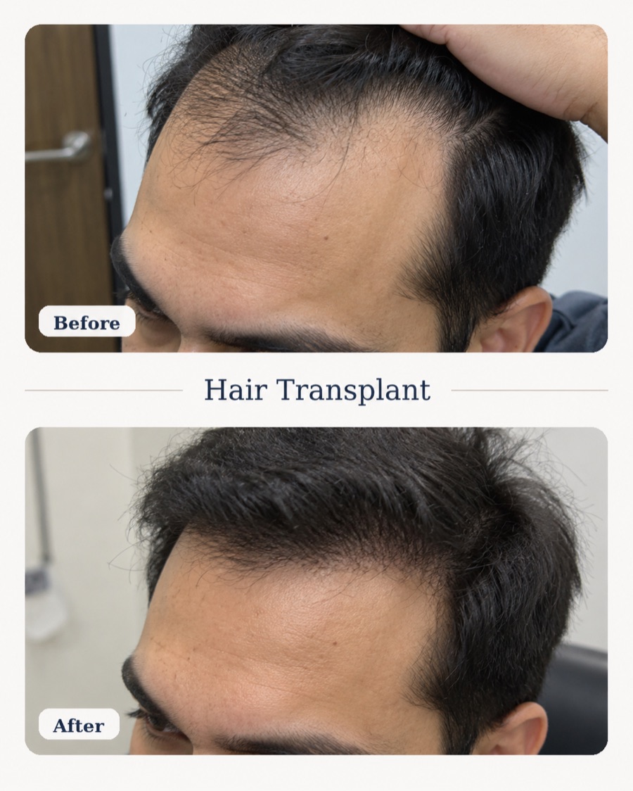 Hair transplant before and after — frontal density restoration