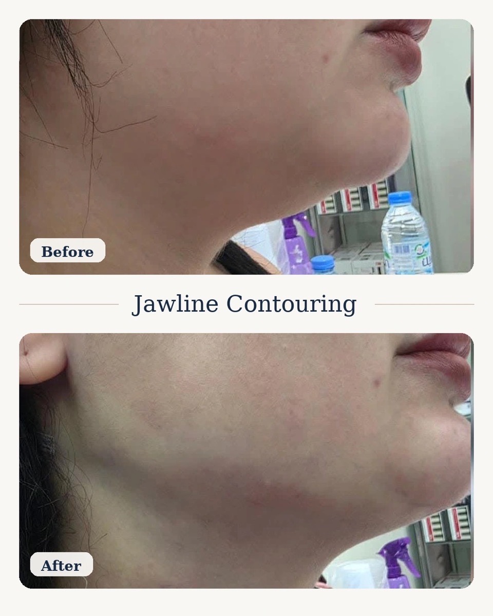 Jawline Contouring
