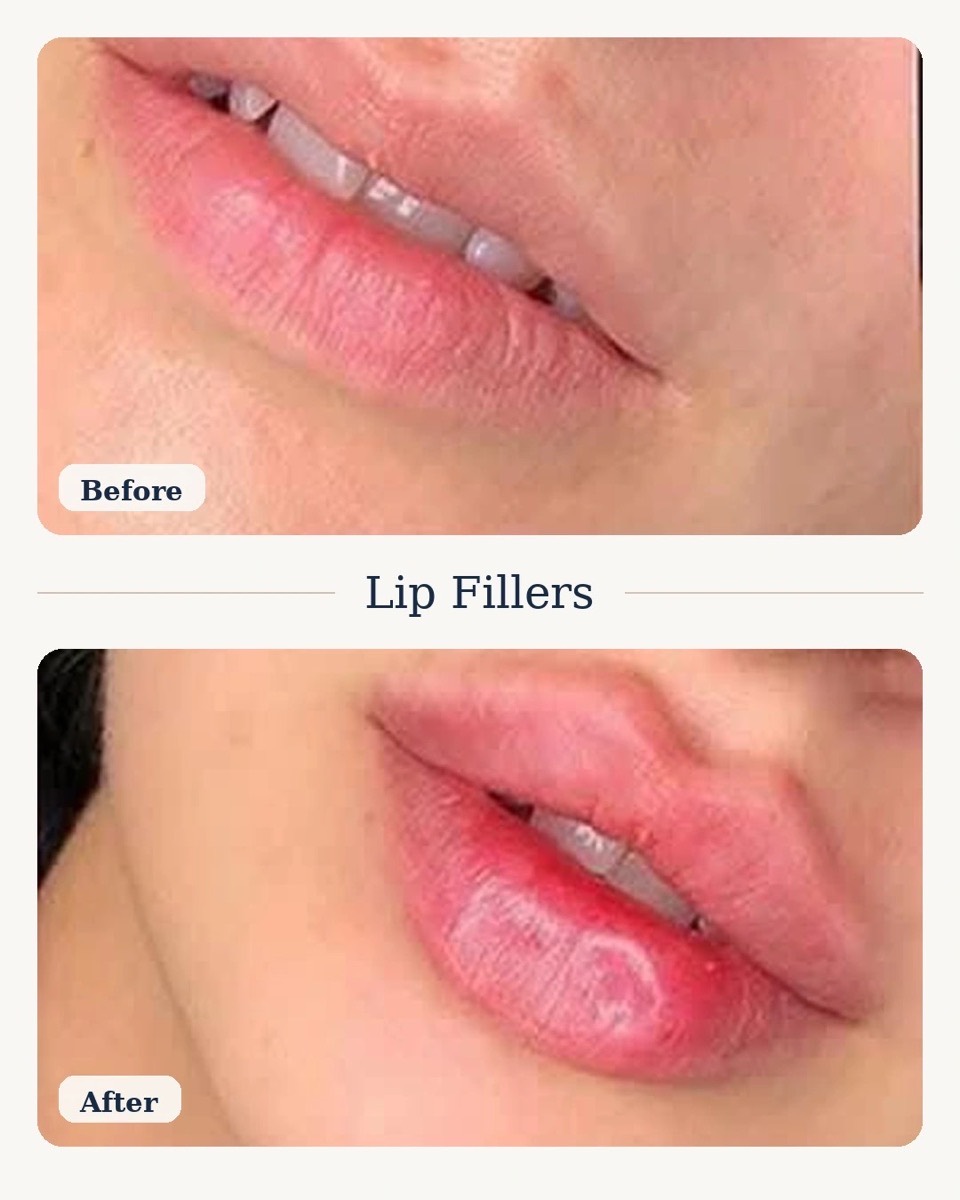 Lip Fillers