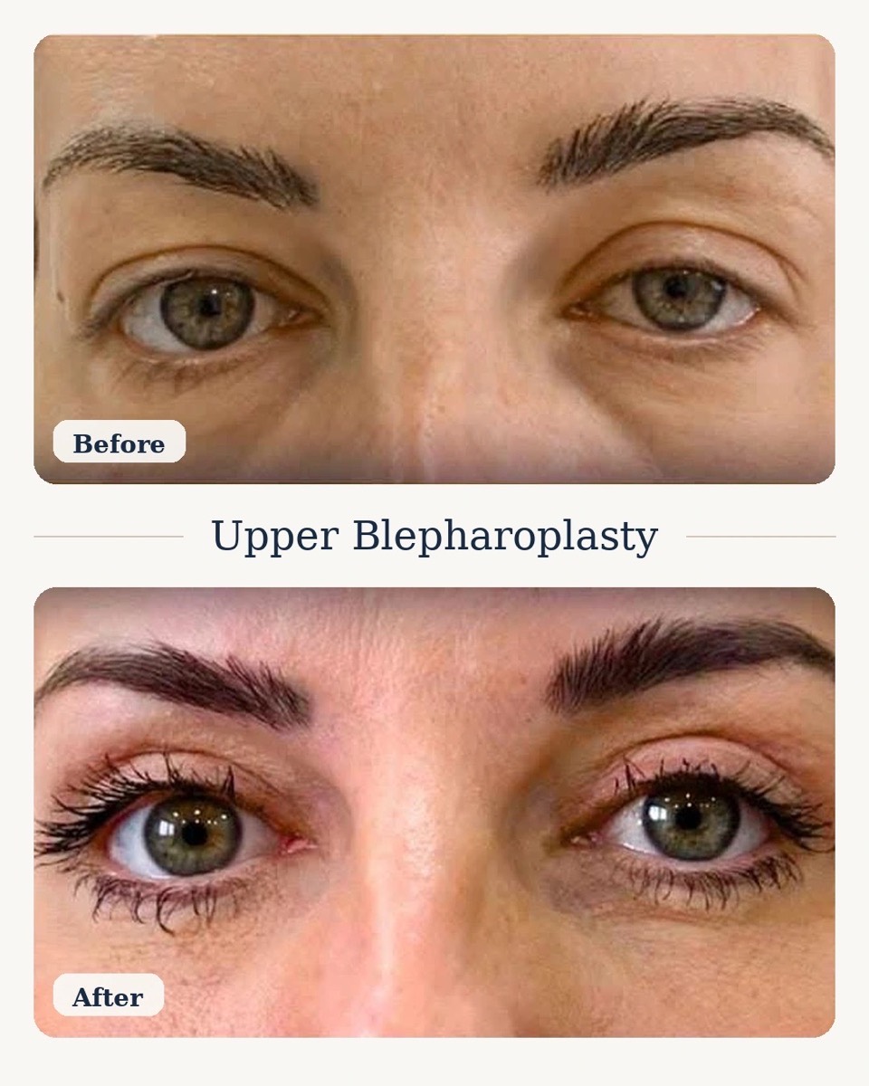 Upper Blepharoplasty